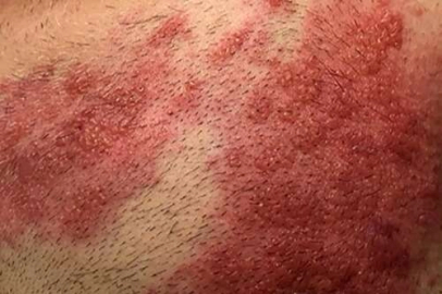 Zayıflayan bağışıklık zona vakalarını artırdı