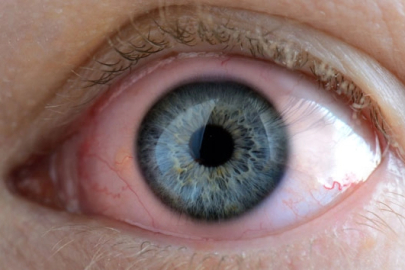 Kış aylarında gözde oluşacak enfeksiyonlara dikkat!