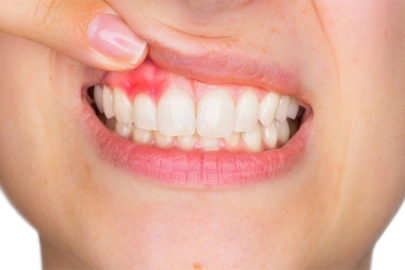 Diş eti hastalıkları, kalp hastalığı ve erken doğum gibi sağlık sorunlarına neden olabiliyor