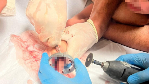 Bursa’da çocuğun parmağı çeşme aynasına sıkıştı