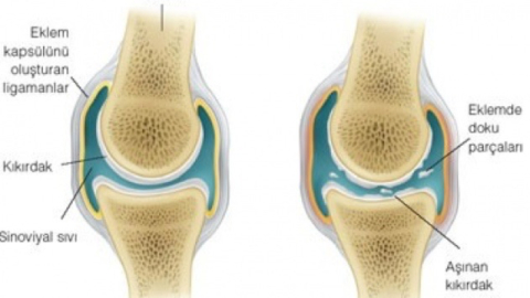 Yaşam koşulları eklem kireçlenmelerini artırıyor