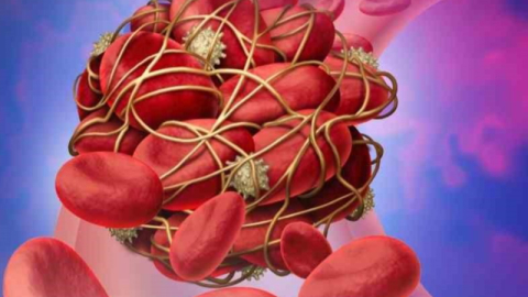 Türkiye’de 30 bin insan tromboz sebebiyle hayatını kaybediyor