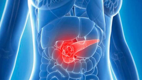 Sessiz katil: ’Pankreas Kanseri’