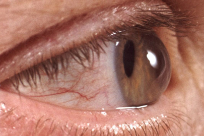 Uzmanlar uyardı! Sürekli gözünüz kaşınıyorsa dikkat!