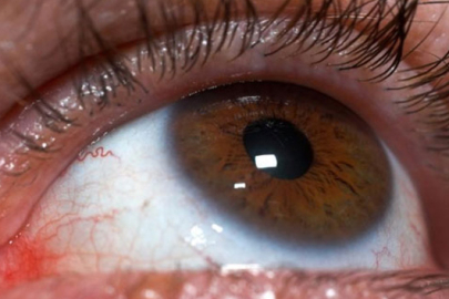 Bahar aylarındaki göz alerjisi görme kaybına yol açabilir