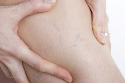 Varisle karıştırılan ödem farklı hastalıkların habercisi olabilir