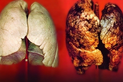 Akciğer kanserinde ölüm oranı ürkütüyor