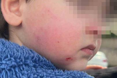 Kreşe bıraktığı çocuğunu darp edilmiş halde aldı