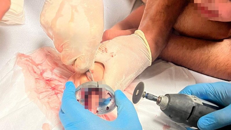 Bursa’da çocuğun parmağı çeşme aynasına sıkıştı