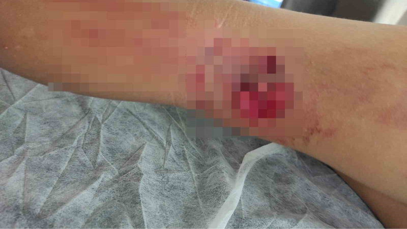 Okula giderken sokak köpeğinin saldırısına uğradı