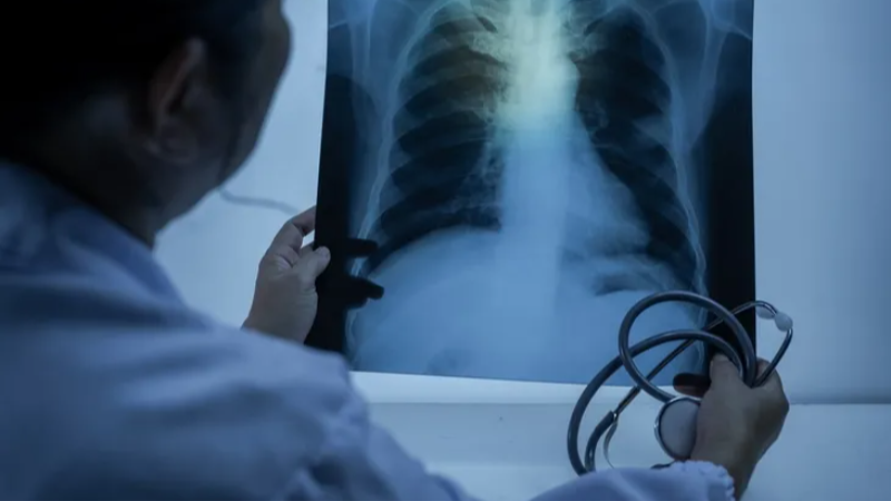 Zatürre toplum sağlığı için büyük tehdit